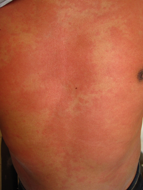 Blanching skin rash located on the abdomen and thorax of the patient
