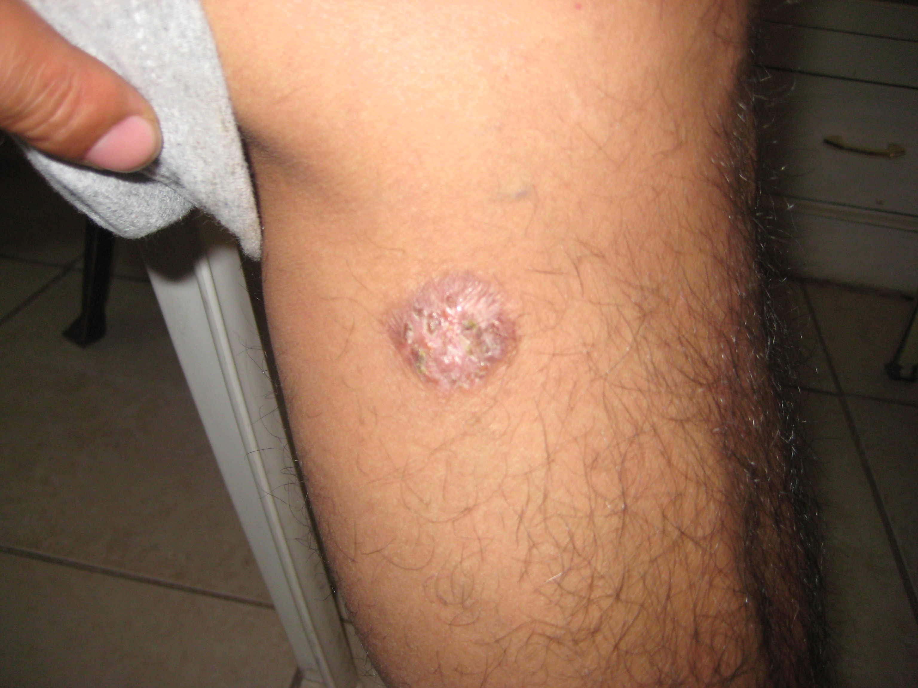 Recognizing Neoplastic Skin Lesions: A Photo Guide ...